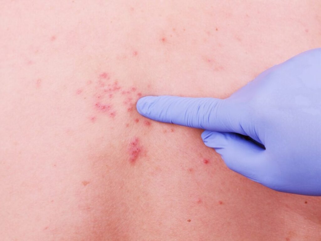 tratamiento-herpes-zoster-1200x900