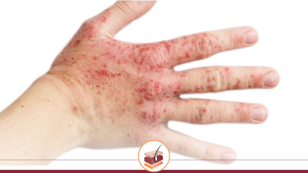 DERMATITIS-DE-CONTACTO