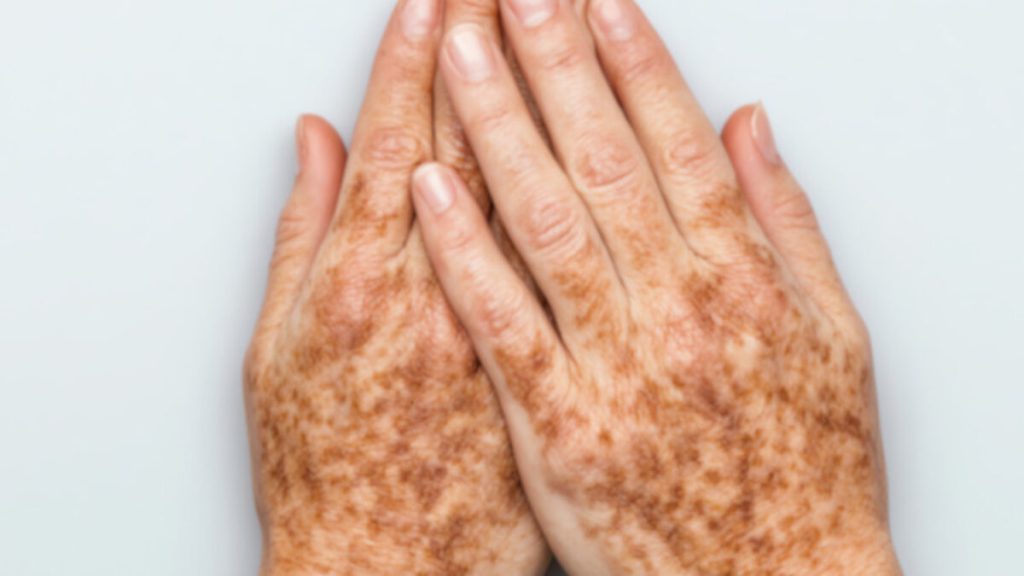 manchas-en-las-manos-1200x675